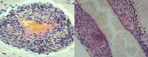 Axial (a) and sagittal planes (b) showing small meningeal and brain arteries with inflammatory infiltration into the walls: lymphocytes, histiocytes, and multinucleated giant cells (H&E×400).