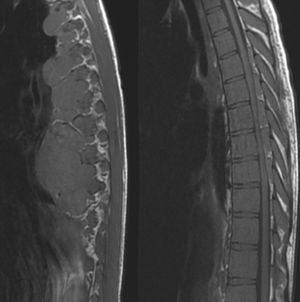 A thoracolumbar MRI scan revealed spinal cord compression due to paravertebral and epidural masses at the level of T5-T9, associated with signs of myelopathy at T9; the paravertebral mass measured 6.8cm×5.1cm on the axial plane. The lumbar spinal cord displayed multiple nodules compressing the thecal sac, compatible with extramedullary haematopoiesis.
