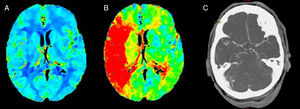 (A) No asymmetries were observed on the cerebral blood volume map. (B) Longer time-to-peak in 6 cortical territories of the right MCA. (C) Occlusion of the right distal M1 segment on the CT-angiography.