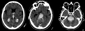 Large brainstem haematoma affecting the pons and extending to the midbrain, diencephalon, third and fourth ventricles, and lateral ventricles. Hyperdense right middle cerebral artery.