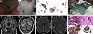 (A and B) Nevus lesions surrounded by depigmentation (halo nevi). (C-F) Brain MRI: right temporomesial and left frontal hyperintense lesions on T1-weighted sequences (red arrows) (C and D), with diffuse subarachnoid hyperintensity on FLAIR sequences (E) and leptomeningeal enhancement with gadolinium (F). (G) CSF cytology study: HMB-45-positive melanin-containing cells. (H) Open meningeal biopsy: dark leptomeninges adhered to the brain parenchyma; minimal touch caused bleeding. (I-L) Anatomical pathology study: atypical melanin-containing cells stained with haematoxylin–eosin (I-J) and HMB-45-positive melanin-containing cells (K and L).