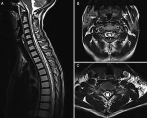 (A) Sagittal T2-weighted MRI sequence of a patient with syringomyelia unrelated to Chiari malformation. (B) Axial T2-weighted MRI sequence at the C2 level. (C) Axial T2-weighted MRI sequence at the C6 level.