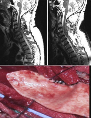 (A) Sagittal T2-weighted MRI sequence showing signs of syringomyelia at T1-T5. (B) Post-surgery sagittal T2-weighted MRI sequence showing resolution of the radiological signs. (C) Duraplasty.