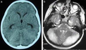(a) Cranial CT scan of patient 2. Slight dilatation of the temporal horns and the third ventricle, which appears more rounded than is normal. Compression of structures of the posterior fossa; the fourth ventricle is not visible. (b) Axial T2-weighted brain MRI sequence from patient 2. Grey matter hyperintensity in both cerebellar hemispheres.