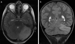 (a) Axial T2-weighted brain MRI scan of patient 6. Signal hyperintensity in the left cerebellar cortex. Hemicerebellitis. (b) Coronal T2-weighted brain MRI scan of patient 6. Hyperintensities affect the left cerebellar cortex exclusively; no white matter hyperintensities are observed.
