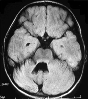 Axial FLAIR brain MRI scan of patient 1. The 15-month follow-up MRI study reveals atrophy of the right cerebellar hemisphere.