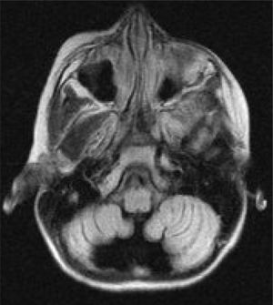 Axial FLAIR brain MRI scan of patient 3. The 32-month follow-up MRI study reveals cerebellar atrophy.