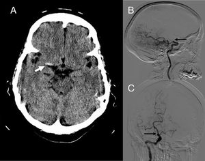 (A) Non-contrast head CT scan showing the “hyperdense middle cerebral artery sign” (arrow), suggestive of a thrombus at this level. Sagittal (B) and coronal (C) sections from the digital subtraction angiography study, revealing an obstruction to contrast flow in terminal internal carotid artery above the exit of the posterior communicating artery (arrow).