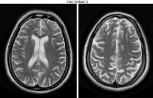 Patient 1. Axial T2-weighted TSE sequence showing cortical retraction with slight dilation of the subarachnoid spaces of the convexity, and discrete enlargement of the supratentorial ventricular system.