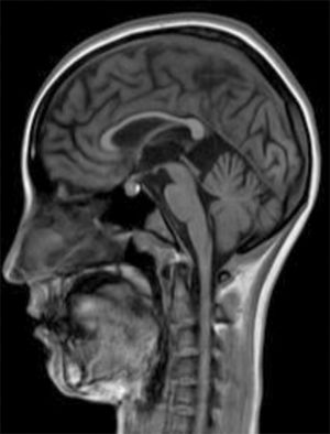Patient 2. T1-weighted TSE sequence revealing slight thinning of the corpus callosum.