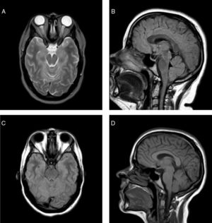Baseline brain MRI: (A) Axial T2-weighted sequence, showing ectasia of the optical nerve sheath, with prominence of both optic discs with signs of IIH. (B) Sagittal FLAIR sequence, showing the partially empty sella turcica. The cerebellar tonsils are mildly herniated, reaching the level of the foramen magnum. Brain MR image obtained 6 months after bariatric surgery. (C) Axial FLAIR sequence, showing resolution of the orbital findings. (D) Sagittal T1-weighted sequence, showing slight retraction of cerebellar tonsils in comparison with the previous study.