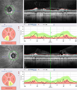 Optical coherence tomography revealing severe atrophy of the peripapillary retinal nerve fibre layers of both optic nerves.