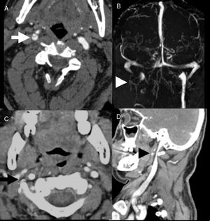 (A) CT angiography (axial) showing right internal carotid artery dissection (arrow). (B) Venous MRI angiography showing absence of flow in the right jugular vein (arrowhead). (C and D) CT angiography sequences revealing bilateral extrinsic compression of the vessel bundle by a giant C1 transverse process (arrow and arrowhead).