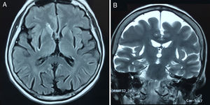 Axial FLAIR (A) and coronal T2-weighted (B) MRI sequences showing bilateral absence of the putamina.