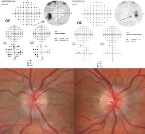 Fundus photograph and 30-2 Humphrey visual field test at 2 weeks of follow-up. The patient displays bilateral papilloedema, stage 3 in the OS and stage 2 in the OD. The visual field test reveals an enlarged blind spot in both eyes, especially the left.