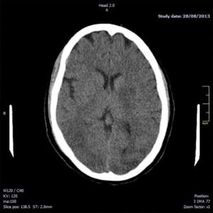 Simple brain CT showing changes suggestive of reversible posterior leukoencephalopathy syndrome.