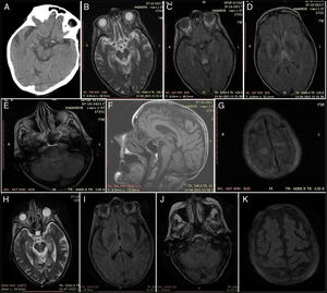 Baseline findings: (A) Head CT at 24hours: hypodensity in the right tectal plate. (B) Axial T2-weighted MRI sequence. (C) Axial FLAIR MRI sequence: lesion to the midbrain periaqueductal region. (D) Axial FLAIR MRI sequence: bilateral thalamic lesions. (E) Axial FLAIR MRI sequence: tectal lesion. (F) Sagittal T1-weighted MRI sequence: no alterations. (G) Axial FLAIR MRI sequence: lesion to the superior frontal cortex and pia mater. Findings at resolution: (H) Axial T2-weighted MRI sequence: regressing periaqueductal lesion. (I) Axial FLAIR MRI sequence: no thalamic lesion. (J) Axial FLAIR MRI sequence: no bulbar lesion. (K) Axial FLAIR MRI sequence: no lesion to the cortex or pia mater.