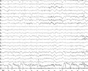 EEG showing slow background activity.