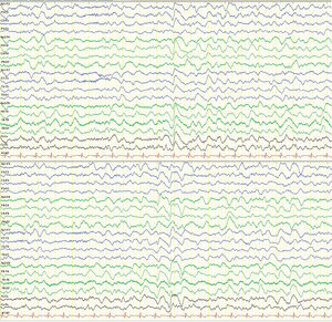 Eletroencephalography performed on day 2 (second episode): longitudinal montage (7μV/mm). Slow background activity, rhythmic delta activity with occasional biphasic and triphasic waves, suggesting diffuse encephalopathy.