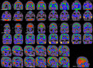 SPECT scan performed on day 16 (second episode): moderate bilateral temporoparietal hypoperfusion, predominantly in the left hemisphere, and mild involvement of the occipital and dorsolateral frontal cortex.