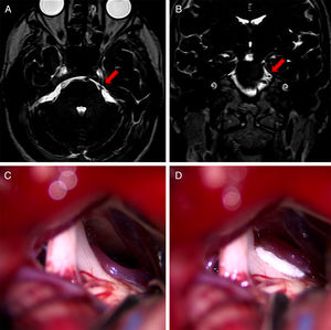 Axial (A) and coronal (B) DRIVE MRI sequences showing contact between the superior cerebellar artery (SCA) and the superior aspect of the left trigeminal nerve (arrow). (C) Microsurgical image of the left cerebellopontine angle showing compression of the trigeminal nerve by the SCA. (D) Decompression of the trigeminal nerve by placing a piece of Teflon®. DRIVE MRI: driven equilibrium magnetic resonanace imaging.