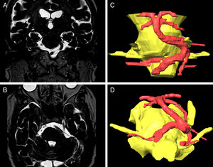 Coronal (A) and axial (B) DRIVE MRI sequences showing compression of the left trigeminal nerve due to vertebrobasilar dolichoectasia. The 3D reconstructions created using the BrainLab software for surgical planning show compression of the medial aspect of the trigeminal nerve. DRIVE MRI: driven equilibrium magnetic resonanace imaging.