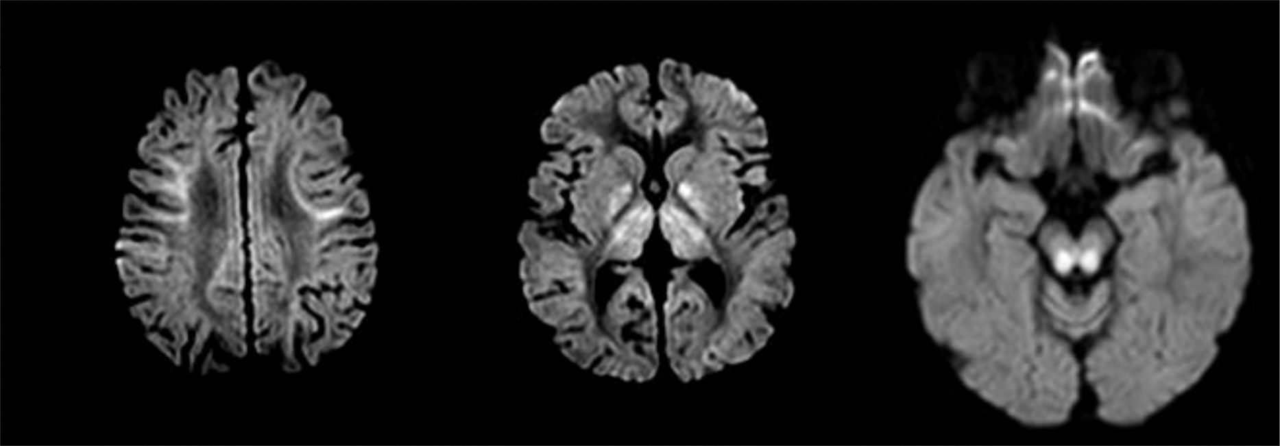 Kearns-Sayre syndrome: Absence of clinical response to treatment with oral  folinic acid | Neurología (English Edition)