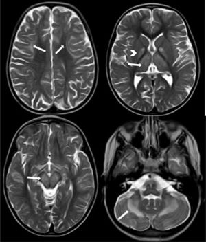 Axial T2-weighted TSE sequence showing signal hyperintensity in the subcortical white matter (U-shaped fibres), which is more pronounced in the frontal lobes (arrows in the upper left image), globi pallidi (arrowhead in the upper right image) and thalami (arrow in the upper right image), brainstem (arrow in the lower left image), and cerebellar white matter, with bilateral, symmetrical involvement.