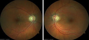 Papilloedema and haemorrhages in both eyes resolved 4 months after withdrawal of carboplatin; the patient was left with papillary pallor in the right eye and atrophy in the posterior pole of both eyes.