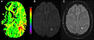 (A) CT perfusion sequence. Time to peak: delay in the posterior territory of the left middle cerebral artery. (B) MRI diffusion-weighted sequence. Cortical and subcortical diffusion restriction in the left parietal region. (C) MRI FLAIR sequence. Left parietal cortico-subcortical lesion (shown in the diffusion-weighted sequences) and bilateral frontal lesions with longer progression times.
