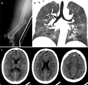 Studies performed upon admission to the emergency department. (a) Lateral radiograph of the left femur showing a displaced transverse fracture of the diaphysis. (b) Chest CT scan, coronal view: bilateral ground-glass opacities in the hilar region and both inferior lobes, typical of CFE. (c) Head CT scan showing no relevant alterations or white matter lesions.