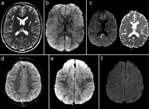 Brain MRI study performed 12 days after symptom onset. (a) Bilateral, frontal deep white matter lesions that are barely visible on T2-weighted sequences (arrows). (b) Diffuse haemorrhagic petechiae affecting the white matter, lentiform nuclei, and splenium of the corpus callosum (arrow) are seen as markedly hypointense punctiform lesions on SWI. (c) The only lesion showing abnormal diffusion restriction (left) was located in the splenium (asterisk) (diffusion-weighted sequence on the right). (d) The T2*-weighted sequence shows less evident haemorrhagic petechiae in the semioval centres; these lesions are more clearly seen on SWI sequences (e) (arrow). (f) The DWI sequence shows no lesions with abnormal diffusion restriction, a typical feature of CFE.
