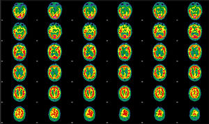Initial brain perfusion SPECT performed after the administration of 925MBq of 99mTc-HMPAO. Representative transaxial tomographic slices are shown. Qualitative assessment detected irregular cortical function in both hemispheres, with more marked hypoactivity in the anterior and orbitofrontal regions, and in the right mesial temporal region. The left hemisphere showed defects in the orbitofrontal, temporobasilar, and mesial regions. Asymmetry is observed in the basal nuclei, with decreased activity on the right side; the cerebellum is unaffected.