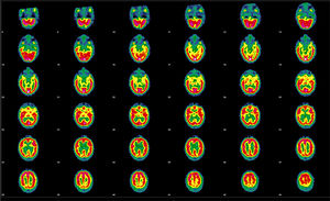 Follow-up brain perfusion SPECT performed after the administration of 925MBq of 99mTc-HMPAO, 20 months after the initial study. Representative transaxial tomographic slices are shown. Irregular cortical function is observed in both hemispheres, with defects of higher intensity in the orbitofrontal and temporal regions and small, diffusely distributed irregularities in the remaining areas of both hemispheres; no alterations are observed in the basal nuclei or cerebellum. Compared with the previous studies, an improvement is observed in the defects in the orbitofrontal and temporal regions, with normal uptake in the anterior frontal region.