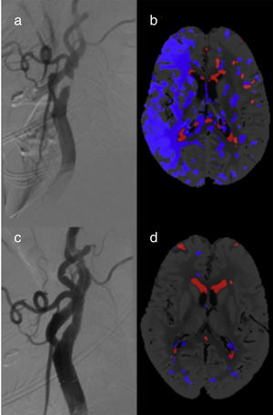 Examples of digital subtraction angiography images and CT perfusion parametric maps (Tmax-CBV) before (a and b) and after carotid angioplasty and stenting (c and d).