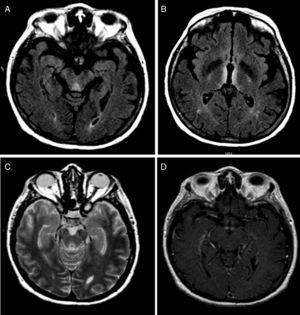 (A) Axial FLAIR sequence showing a hyperintense area in the tectum. (B) Axial FLAIR sequence showing bilateral, symmetrical hyperintensities in the thalamus and fornix. (C) Axial T2-weighted sequence revealing a periaqueductal hyperintense lesion. (D) T1-weighted sequence revealing contrast uptake in the mammillary bodies.