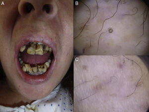 (A) Gingivitis and teeth deformities. (B) Dermoscopic image of a corkscrew hair. (C) Dermoscopic image of follicular purpura.