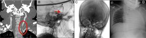 (A) Coronal CT angiography slice showing the origin of the left vertebral artery and its narrowing, which confirms arterial dissection. (B) Angiography with lateral projection confirming thrombosis of the distal third of the basilar artery. (C) Angiography with frontal projection following mechanical thrombectomy, displaying complete recanalisation. (D) Chest radiography with the patient in the supine position, revealing left hemithorax opacification.