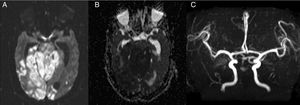 MRI and MRI angiography studies. (A and B) Axial DWI and ADC sequences, respectively, revealing extensive acute ischaemic stroke involving the pons, cerebellum, and bilateral occipital region. (C) MRI angiography sequence showing absence of blood flow in the basilar artery, confirming rethrombosis.
