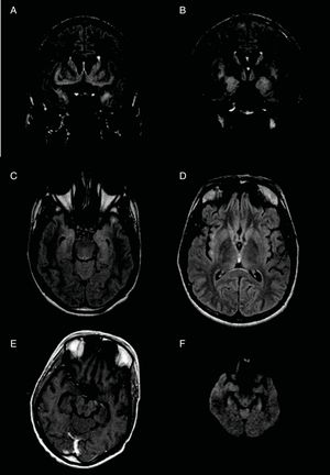 Brain MRI showing cortical hyperintensity on coronal T2-weighted FLAIR (A and B) and axial T2-weighted sequences (C and D), affecting the bilateral hippocampi, amygdalae, temporal lobes, basal and parasagittal regions of the frontal lobes, insulae, globus pallidi, and caudate nuclei. No pathological enhancement was observed after intravenous administration of contrast (E). Lesions do not cause a mass effect or show diffusion restriction on DWI sequences (F).