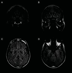 Follow-up MRI scan performed 12 months after antibiotic treatment completion, showing improved parenchymal involvement. Mild hyperintensity persisted in the temporal and perisylvian regions on axial (A and B) and coronal FLAIR (C and D) sequences.