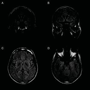 Follow-up MRI scan performed 12 months after antibiotic treatment completion, showing improved parenchymal involvement. Mild hyperintensity persisted in the temporal and perisylvian regions on axial (A and B) and coronal FLAIR (C and D) sequences.