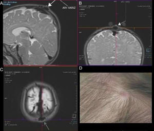 (A) Sagittal T2-weighted MRI sequence. The white arrow (signal voids) points to the varicose vein draining to the sagittal sinus. (B) Coronal slice at the level of the varicose vein (white arrow). Protrusion is observed at the surface. (C) Axial sequence showing the lesion at the midline. (D) External appearance of the Sinus pericranii. A macule is visible on the scalp; its size fluctuated during examination.