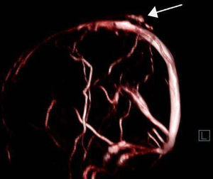 MR angiography (magnetic resonance venography). The white arrows points to a varicose vein with pericranial drainage, communicating with the sagittal sinus through a transosseous vein.
