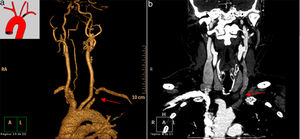(a) MRI angiography of the thoracic aorta rendering reconstructions and (b) chest MRI angiography showing complete obstruction of the proximal third of the left subclavian artery, with contrast uptake in the post-stenotic area through the left vertebral artery.