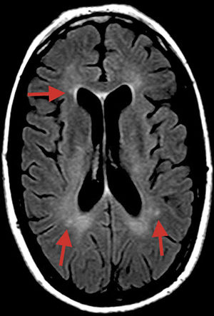 T2-weighted FLAIR sequence (axial plane) taken at symptom onset, revealing small hyperintensities (arrows) in the subcortical and periventricular white matter.