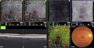 OCT-A image of the right eye revealing loss of superficial and deep retinal capillaries in the inferior temporal region (ischaemic areas marked by a circle).