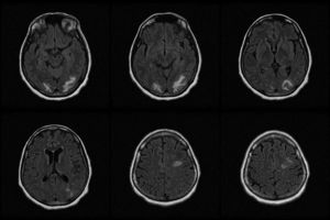 MRI study showing signs of reversible posterior leukoencephalopathy syndrome. Subcortical white matter hyperintensities are observed in both occipital lobes, with focal extension to the left parietal and frontal areas.