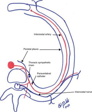 Location of the paravertebral catheter and its anatomical relationship with the sympathetic chain and the intercostal nerve.