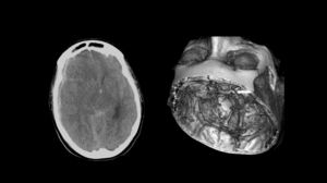 Fifty-three-year-old woman who presented sudden headache with loss of consciousness. Emergency services intubated the patient and transferred her to hospital, where she was diagnosed with SAH with acute subdural haematoma caused by a ruptured aneurysm in the posterior communicating artery (arrow). She was transferred to another hospital with a weekend on-call service for SAH; a craniectomy was performed to evacuate the acute subdural haematoma and subsequent aneurysmal embolisation. The patient died 13 days later.